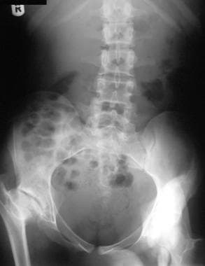 Plain abdominal radiograph in a 19-year-old man wi