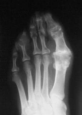 Radiograph of the foot in a patient with chronic g