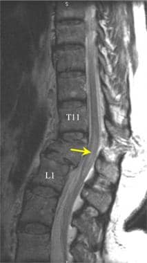 Thoracic spine trauma. Chance fracture of the T12 