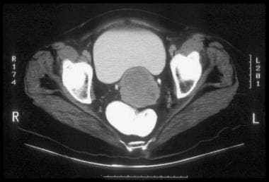 CT of clinically visible carcinoma confined to the
