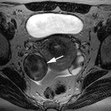 T2-weighted magnetic resonance image of an adnexal