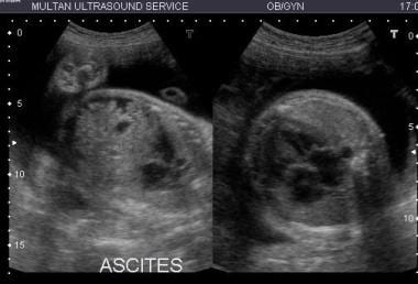 Twin-twin transfusion syndrome. The recipient twin