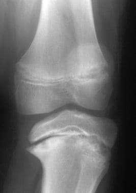 Blount Disease Imaging: Overview, Radiography, Magnetic Resonance Imaging