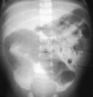 Hirschsprung disease. Frontal abdominal radiograph