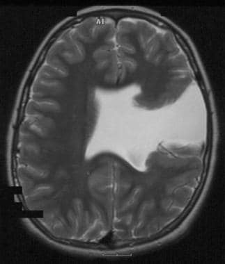 Schizencephaly. Axial T2-weighted MRI in unilatera