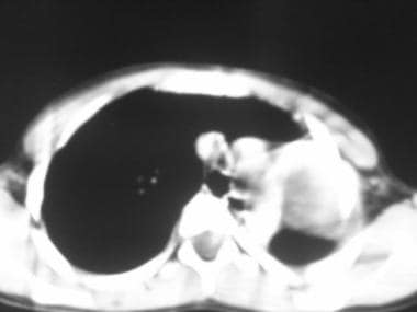 Computed tomography scan (mediastinal window) show