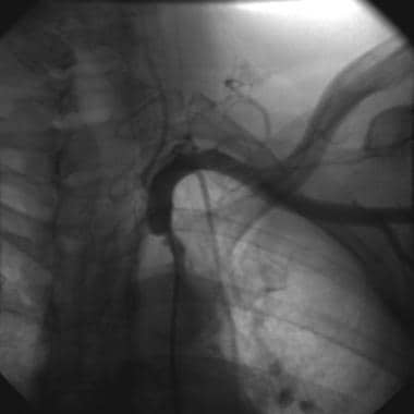 Left subclavian artery stenosis. 