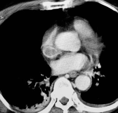 Superior vena cava syndrome in a patient with lung