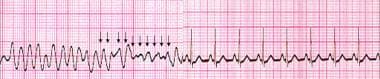 Ventricular fibrillation terminated by an unsynchr