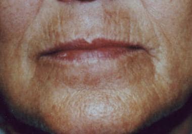 Facial Analysis for Skin Resurfacing: Overview, Preoperative History ...