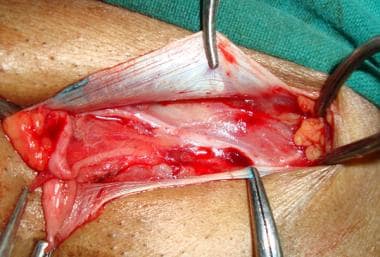 Open inguinal hernia repair. Superior flap of exte
