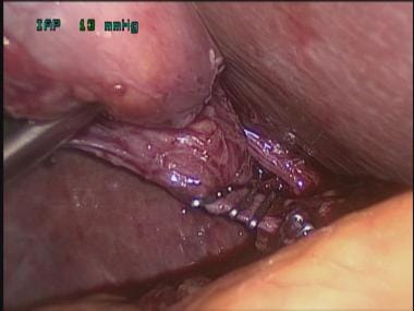 Transvaginal cholecystectomy. Clips on cystic arte