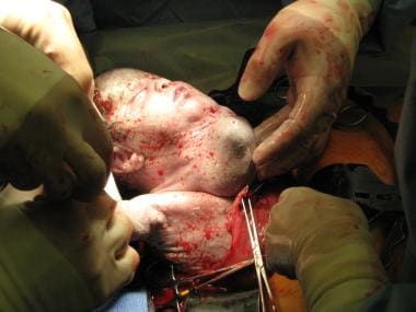Cervical Teratoma in an infant delivered via EXIT 