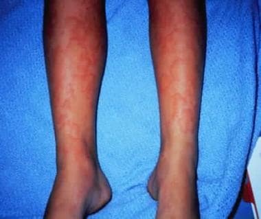 Urticaria associated with a drug reaction. 