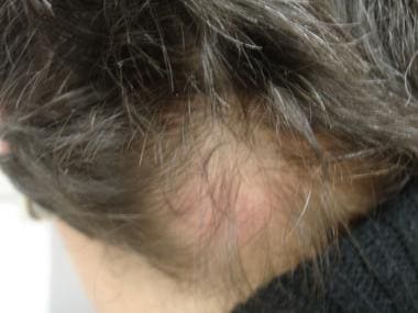 Alopecia due to primary cutaneous follicular cente