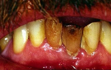 Intrinsic dental discoloration caused by blunt tra