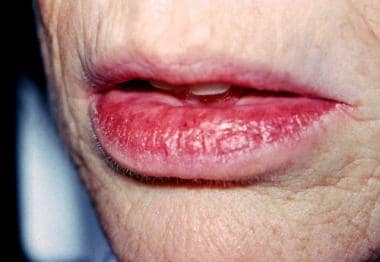 infectious cheilitis