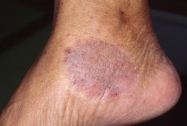 Bazex syndrome. Violaceous psoriasiform dermatitis