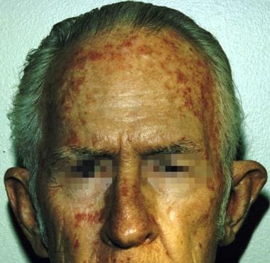 actinic keratosis horn