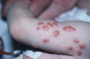 Nodular scabies in an infant. Courtesy of Kenneth 