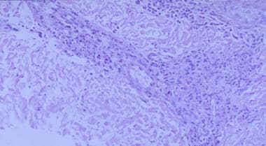 Leukocytoclastic vasculitis and fibrinoid necrosis