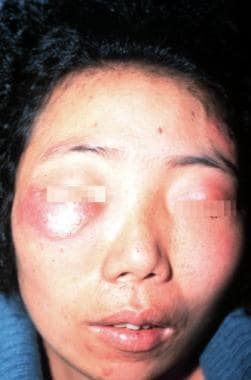 Erythema Nodosum Face