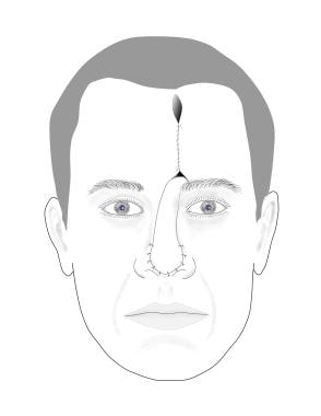 Pedicle/Interpolation Flaps Treatment & Management: Surgical Therapy ...