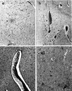 Paraneoplastic autonomic neuropathy. Central nervo