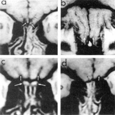 MRI of the brain in patients with Kallmann syndrom