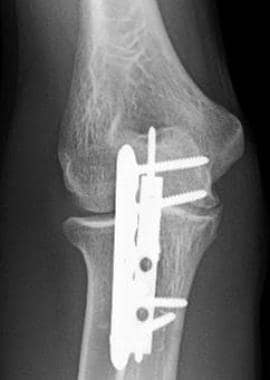 AP radiograph of healed olecranon nonunion after o