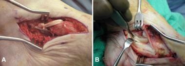 Intraoperative images from patient with pes planus
