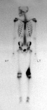 Bone scan of a low-grade central osteosarcoma of t