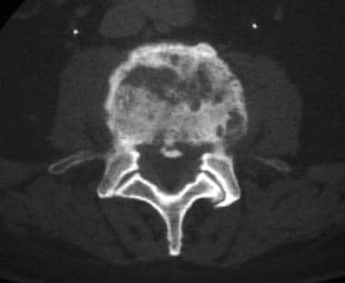 Axial CT scan in a patient with diskitis demonstra
