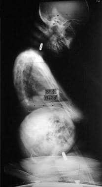 Neuromuscular scoliosis. Preoperative lateral spin