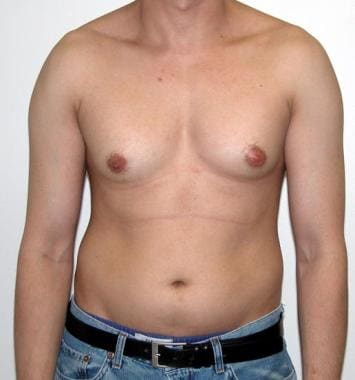 Resulta ng larawan para sa Gynecomastia