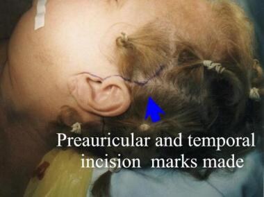 Preauricular and temporal incision markings in pla