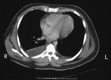 Right-sided pleural effusion in a patient with sma