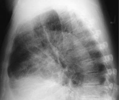 Lateral chest radiograph shows prominent interstit