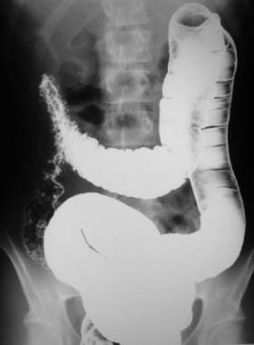 Crohn disease. This double-contrast barium enema s