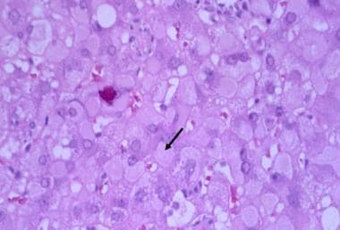 hepatitis b liver histology