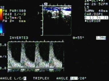 Completion duplex ultrasonographic study shows exc