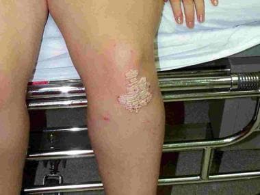 psoriasis knee