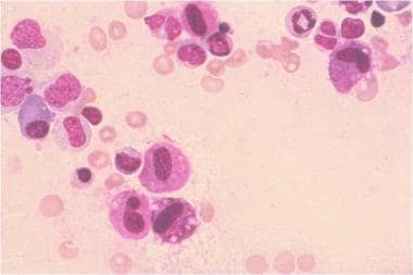 Systemic mastocytosis. Bone marrow aspirate, Roman