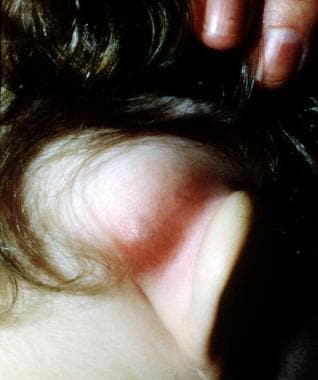 mastoiditis symptoms