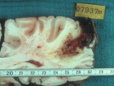 Brain metastasis of alveolar echinococcosis. Court