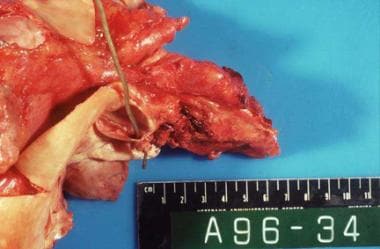 Acute bacterial endocarditis caused by Staphylococ