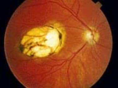 Ophthalmic toxoplasmosis. Used with permission of 