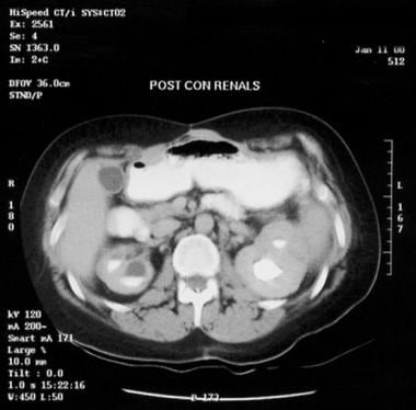 When Is A Noncontrast Ct Scan Of The Kidneys Ureters And Bladder Kub Or A Ct Urogram Indicated In The Evaluation Of Acute Pyelonephritis Kidney Infection