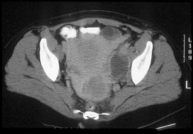 CT scan of cervical cell carcinoma demonstrates ma