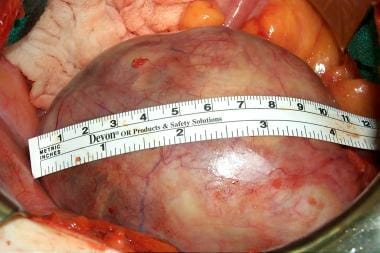 A 12-cm mature cystic teratoma of the ovary prior 